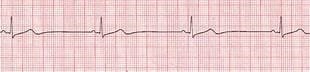 SINUS BRADYCARDIA