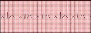 First Degree Heart Block