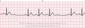 Second Degree Heart Block