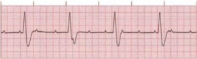 Complete Heart Block