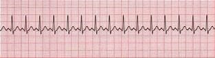 Sinus Tachycardia