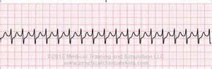 Supraventricular Tachycardia
