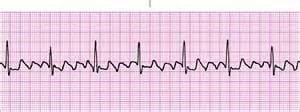 Atrial Flutter