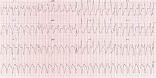 Ventricular Tachycardia