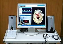 TRANSCRANIAL DOPLER