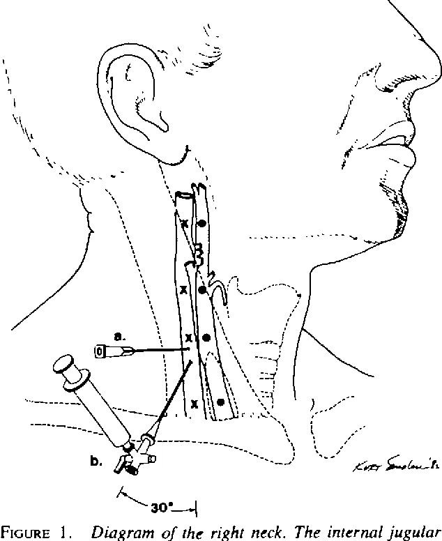 Jugular venous oxygenation monitoring